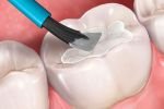 Зачем нужно глубокое фторирование зубов? Рассказывает стоматолог Капил Кхурана